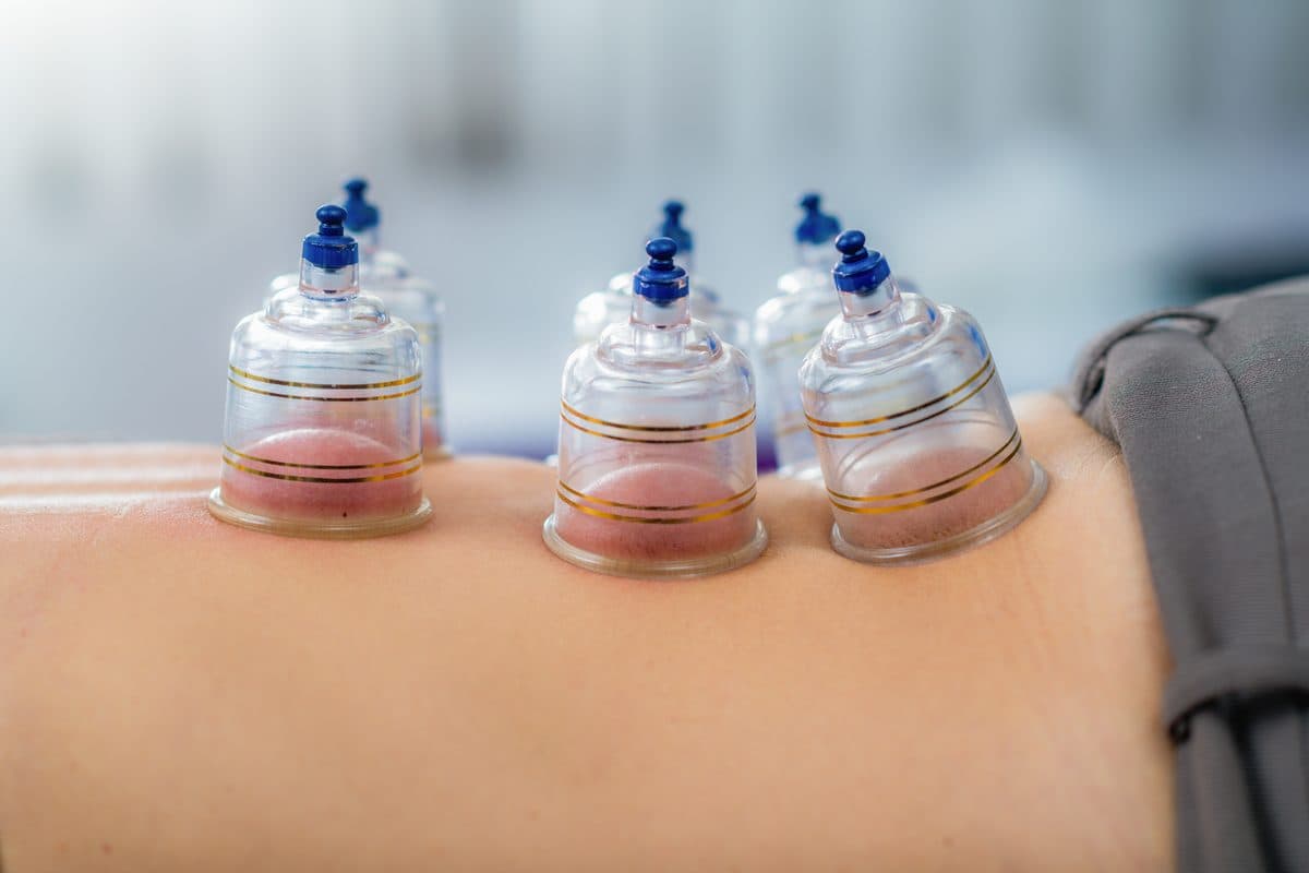 Terapia de cupping en la espalda